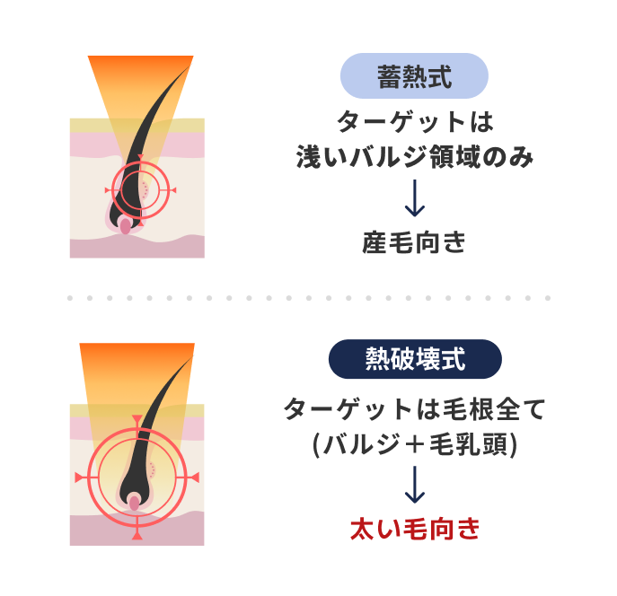 脱毛機械の違い