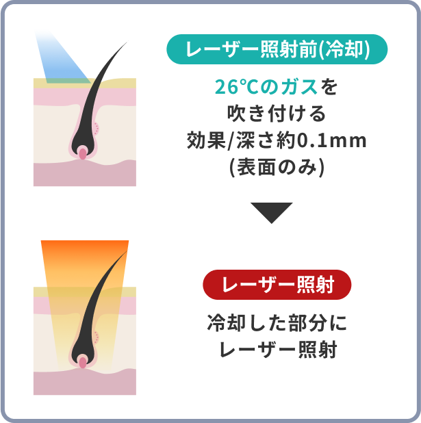 レーザー照射
